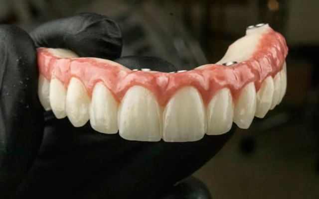 Implantes dentários