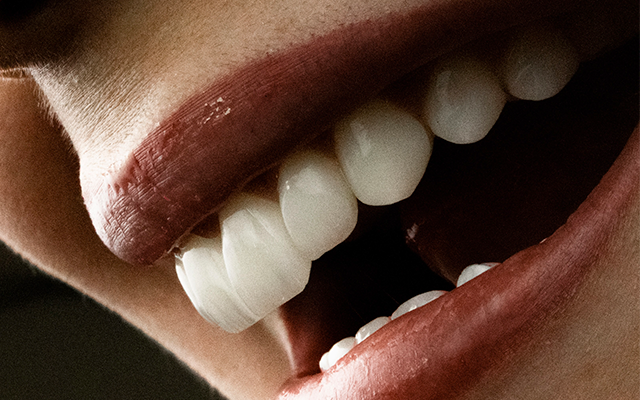 Facetas dentárias